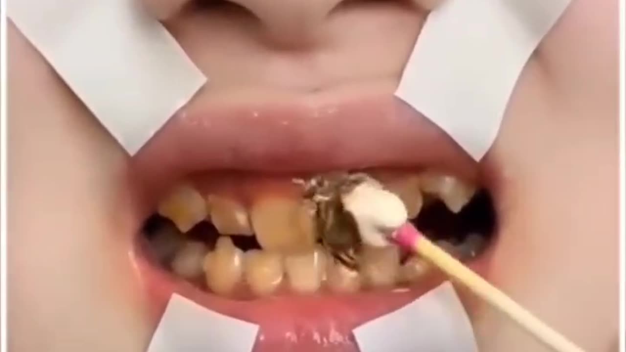 Dental Calculus Removing Toothpaste