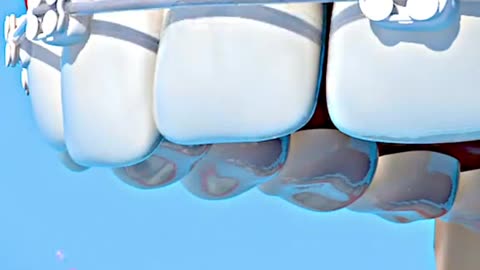 Orthodontic Braces Placement