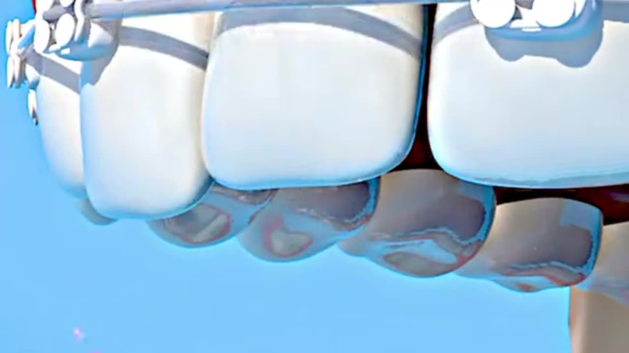 Orthodontic Braces Placement