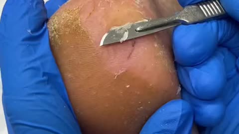 Painful heel callus removal by Australian podiatrist