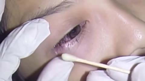 Eye Zit Removal with a Cotton Pledget