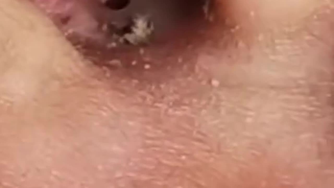 Remove Dangerous Blackhead