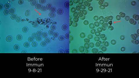 Blood work before and after JJ vaccine and medical treatment during 29 days