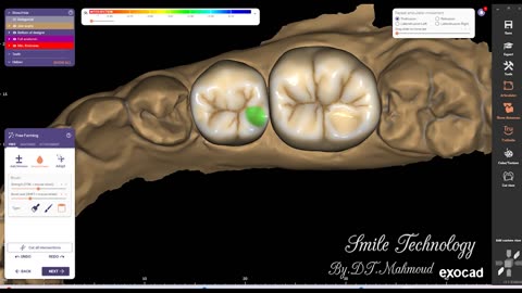#design #naildesign #dental #dentaldesign #exocadexpert