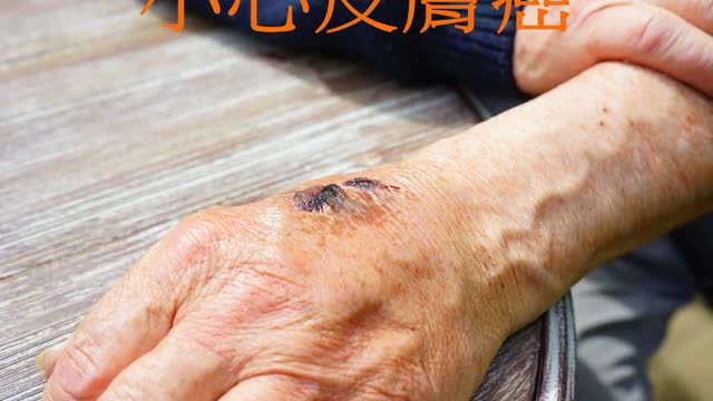 傷口久不癒合？ 小心皮膚癌