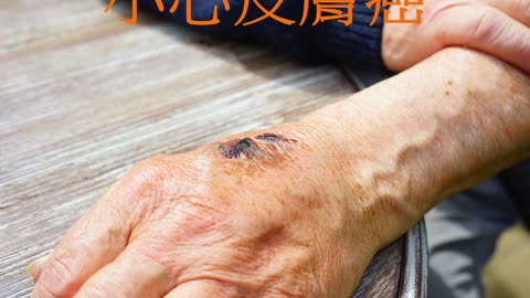 傷口久不癒合？ 小心皮膚癌