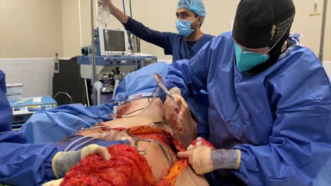 Dermal Flap and Thigh Reduction | PLASTIC SURGERY PROCEDURE