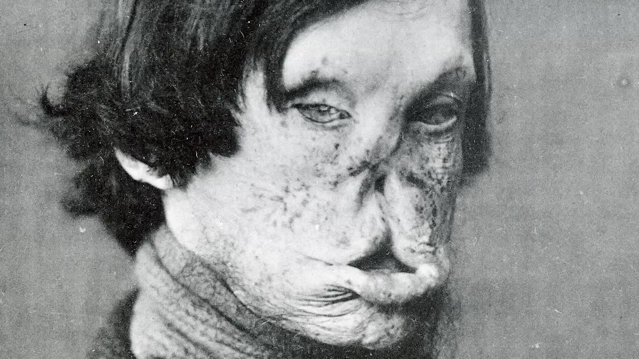 The horrifying history of leprosy| disturbing history #scary