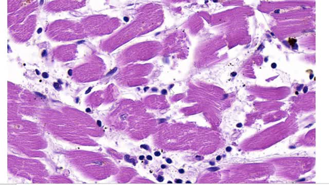 Myocarditis after vaccination, photographic evidence