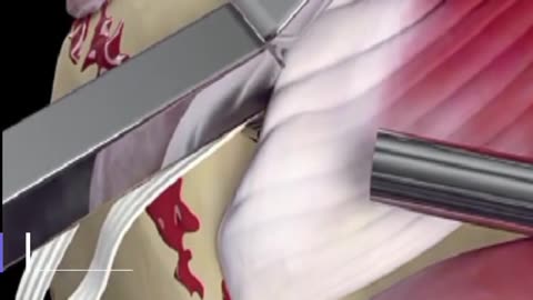 how to fix shoulder bond #shorts