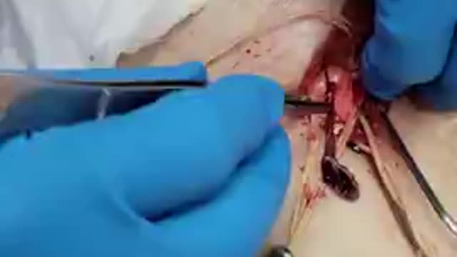 Richard Hirschman (Embalmer) - Unbelievable Blood Clots From Gene Shot, Seen In This Video