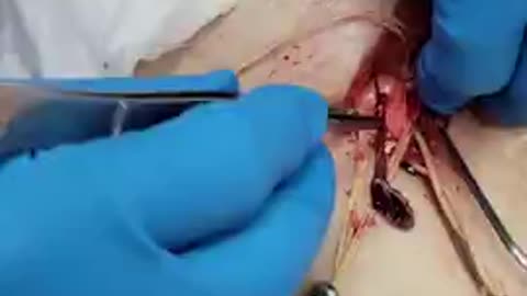 Richard Hirschman (Embalmer) - Unbelievable Blood Clots From Gene Shot, Seen In This Video