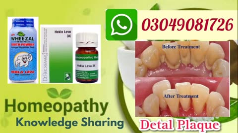 Dental Plaque | Causes, Treatment & Removal homeopathic medicine hakla lawa @DrAbdulManan