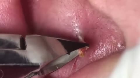 Blackhead in ear