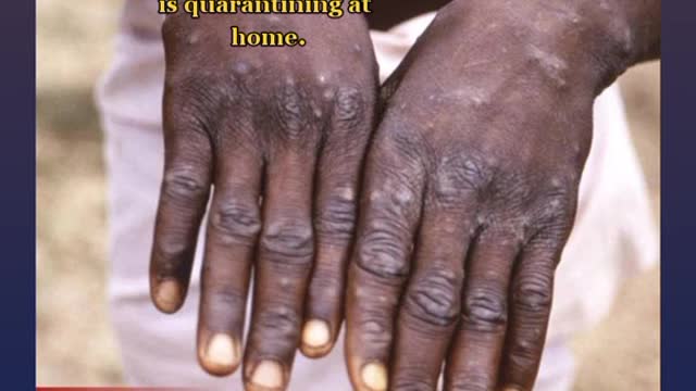 The health ministry has confirmed Jamaica’s third case of monkeypox