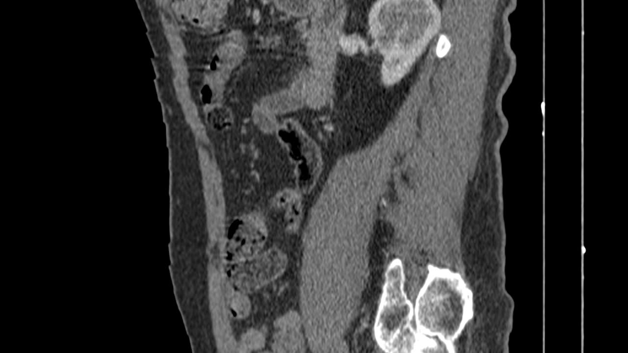 Thoracoabdominal CT angiography, sagittal view