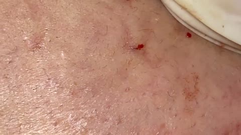 Pimple Popping