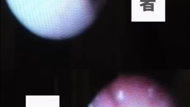 “日本臨床醫訊”_新冠實驗針劑接種者與非接種者，咽喉鏡檢比較發現！同樣感染狀況，“接種者”咽喉顯得更為紅腫且很可能因“新冠實驗針劑副作用”而患上“慢性咽喉炎”！