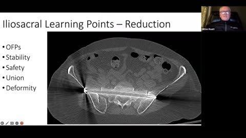 AO Trauma NA Fellows Webinar Pelvis: Percutaneous Fixation - Indications and Limits
