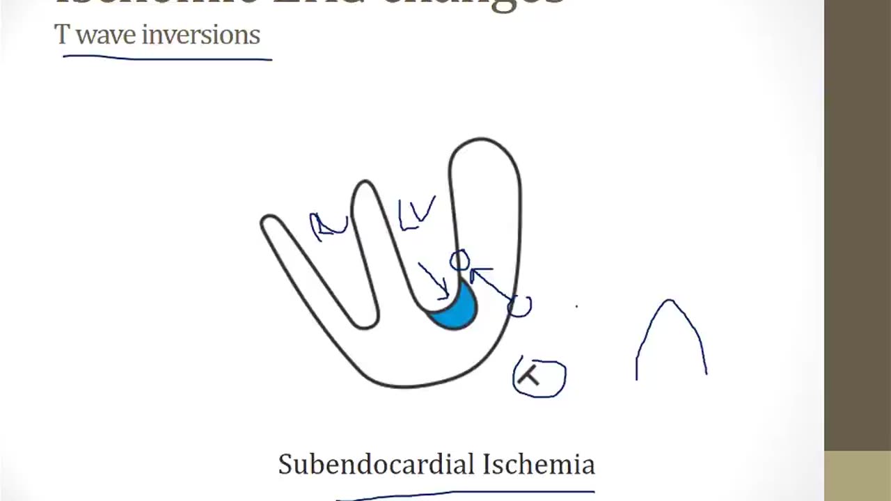 01 Cardiac Ischemia bnb video