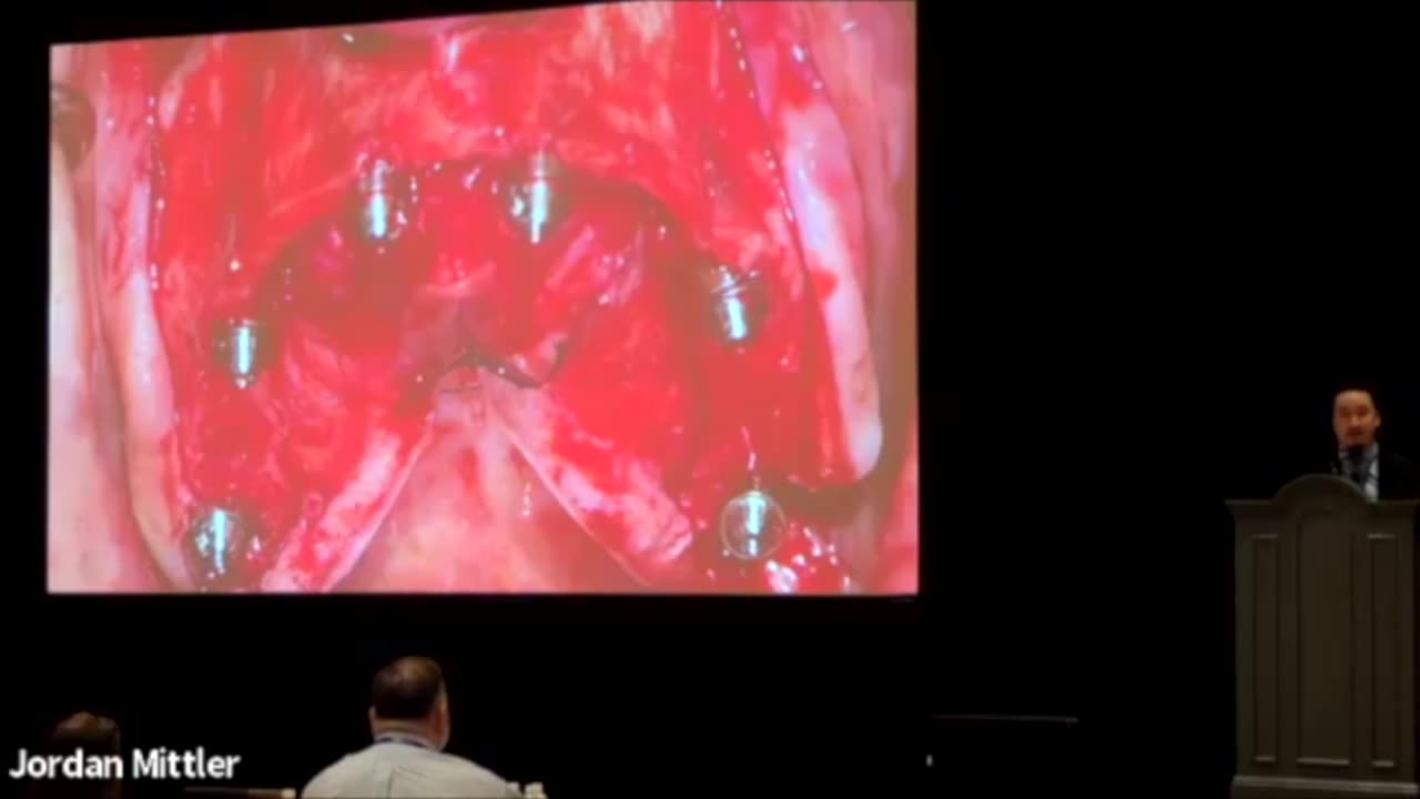 The Patient Who Needs a Full Arch Maxillary Prosthesis