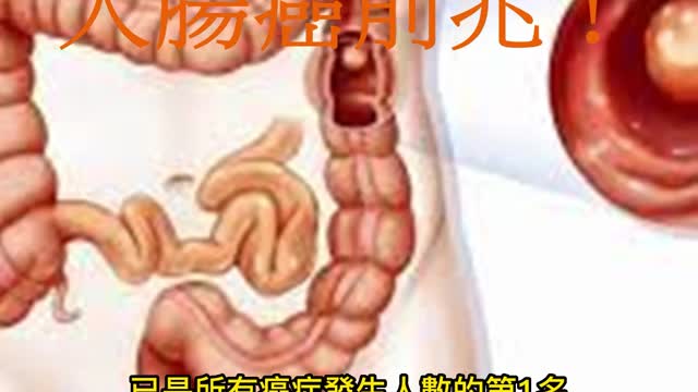 大便有血、變細 大腸癌前兆!