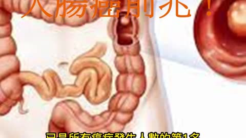 大便有血、變細 大腸癌前兆！