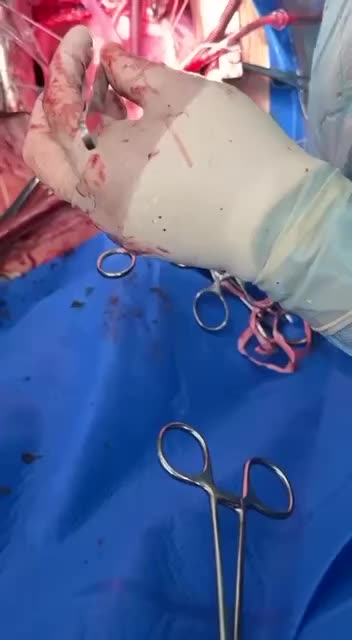 🔞 Removing a bullet fragment from a soldier’s heart..