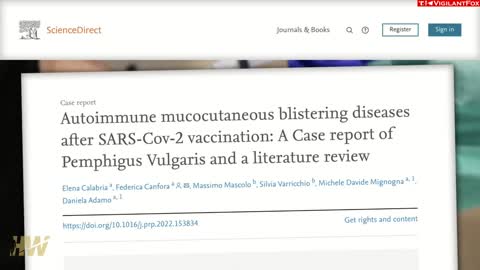 Blistering, in mouth and nose due to vax
