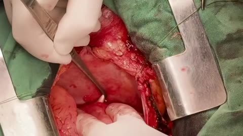 Ukrainian Surgeon Remove a 7.62 Bullet from the Beating Heart of a Ukrainian Soldier