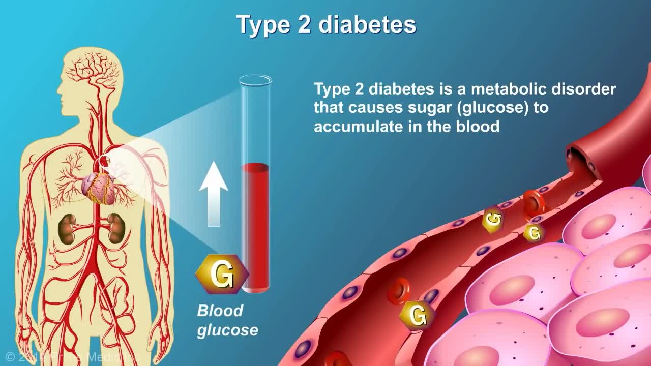 Understanding Type 2 Diabetes