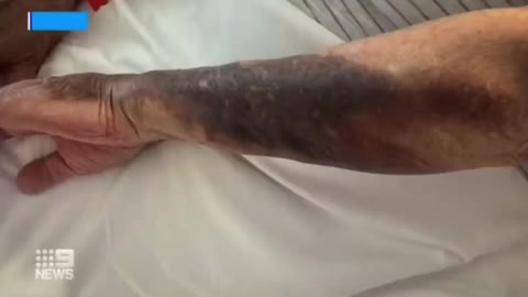 Mainstream news: Side Effects After Taking the Covid Shot.