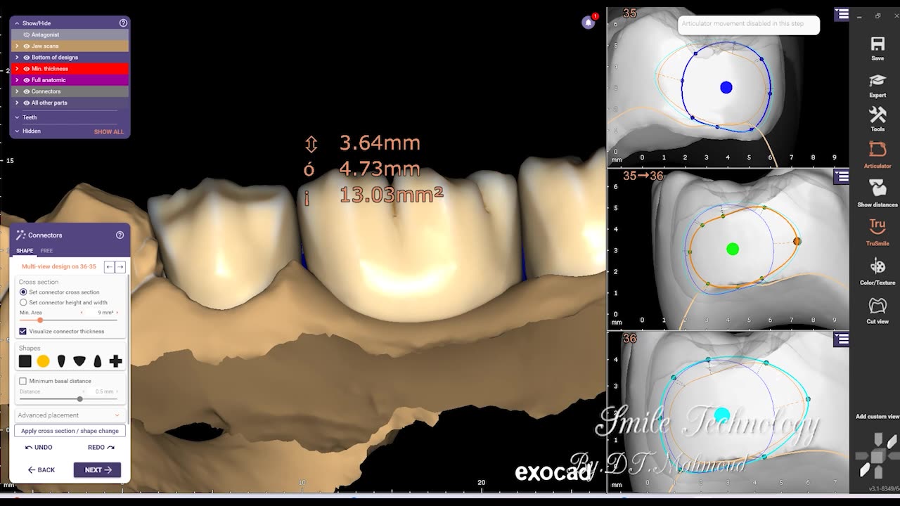 #design #naildesign #dental #dentaldesign #exocadexpert