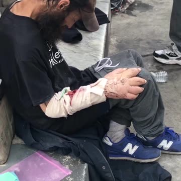 What’s wrong with his hand?