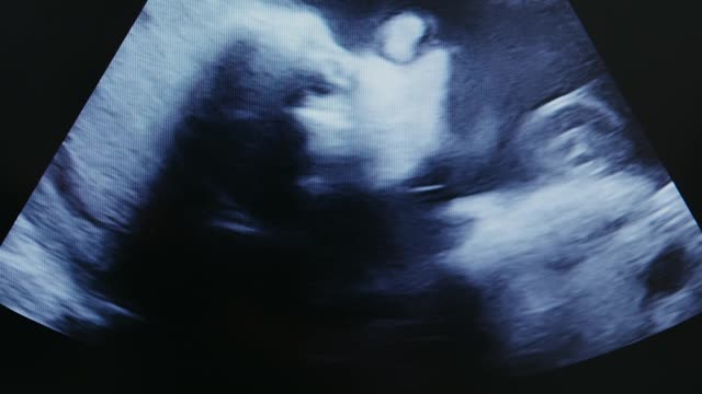 An X-Ray of A Baby During Pregnancy
