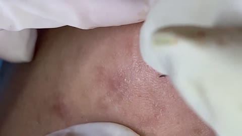 Big Cystic Acne Blackheads Extraction Blackheads & Milia, Whiteheads Removal Pimple Popping