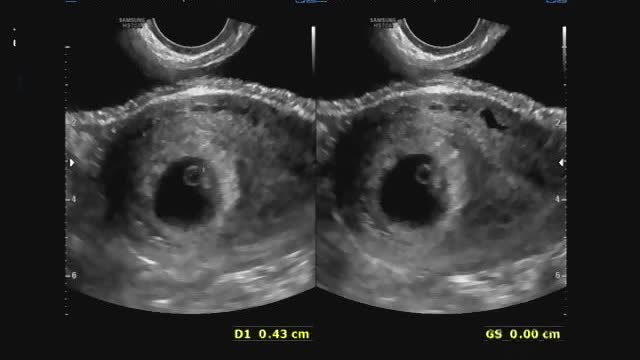 fetal ultrasound