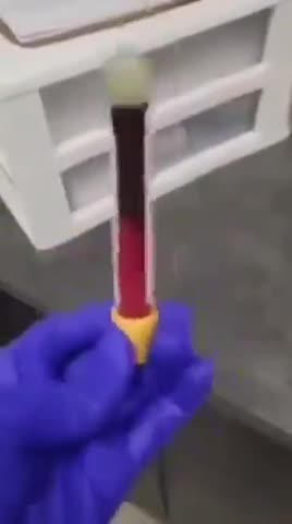Hematologist says that her Patients Drawn Blood Clotted in 3 Minutes