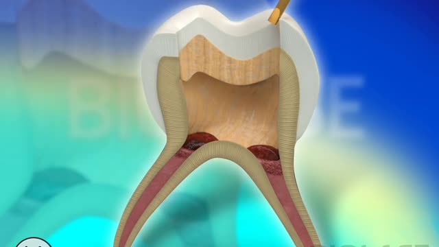 Dental Restoration with Waterlase Laser Dentistry - BIOLASE