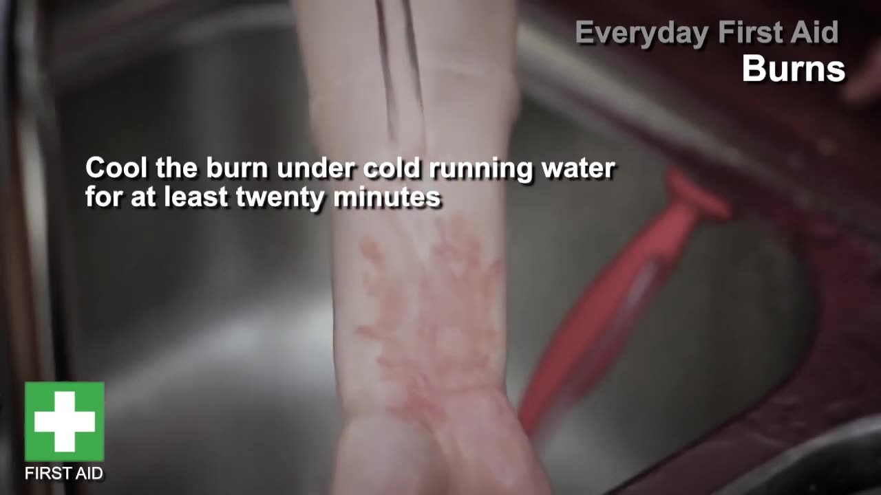 First Aid | Helping someone who has a burn | British Red Cross