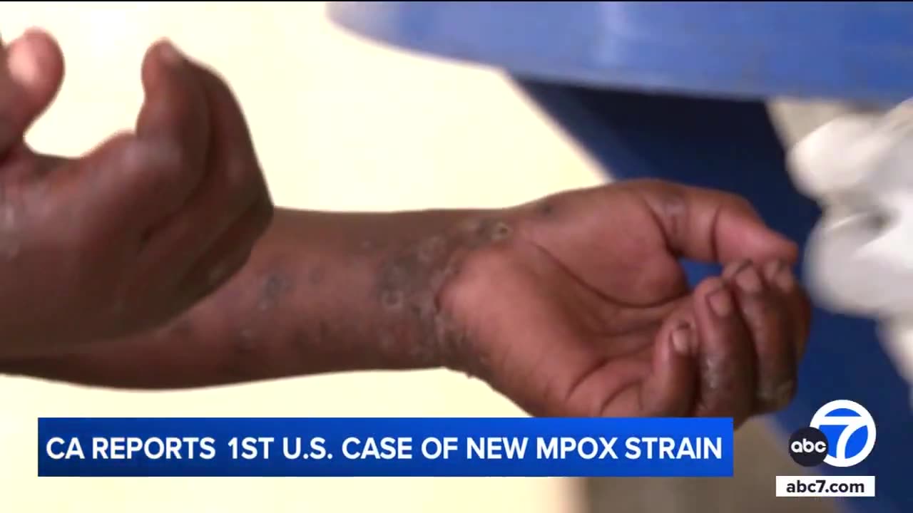 1st known US case of new strain of mpox is confirmed in California