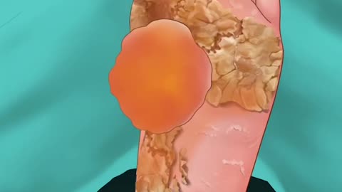 ASMR Treatment of Acid Burned Feet so Satisfying #trending #trendingshorts #viral #satisfying #asmr