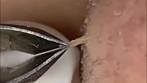 19-#satisfyingvideo #blackhead #whiteheads #extract