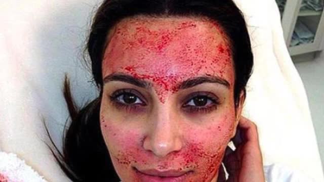 Vampire Facial Miami