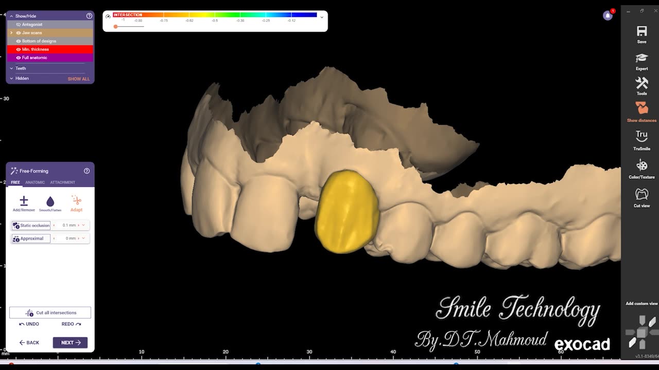 #design #naildesign #dental #dentaldesign #exocadexpert