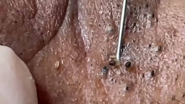 Giants Deep Blackheads, Whiteheads, Big Pimples, Hidden Acne Removal - Best Popping Videos #000001