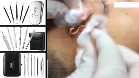 Blackheads Removal & Pimple Popping Video
