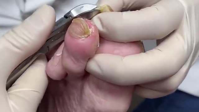 6 EXTREME nail cut years long nails, ram's horn fungal toenails and more!