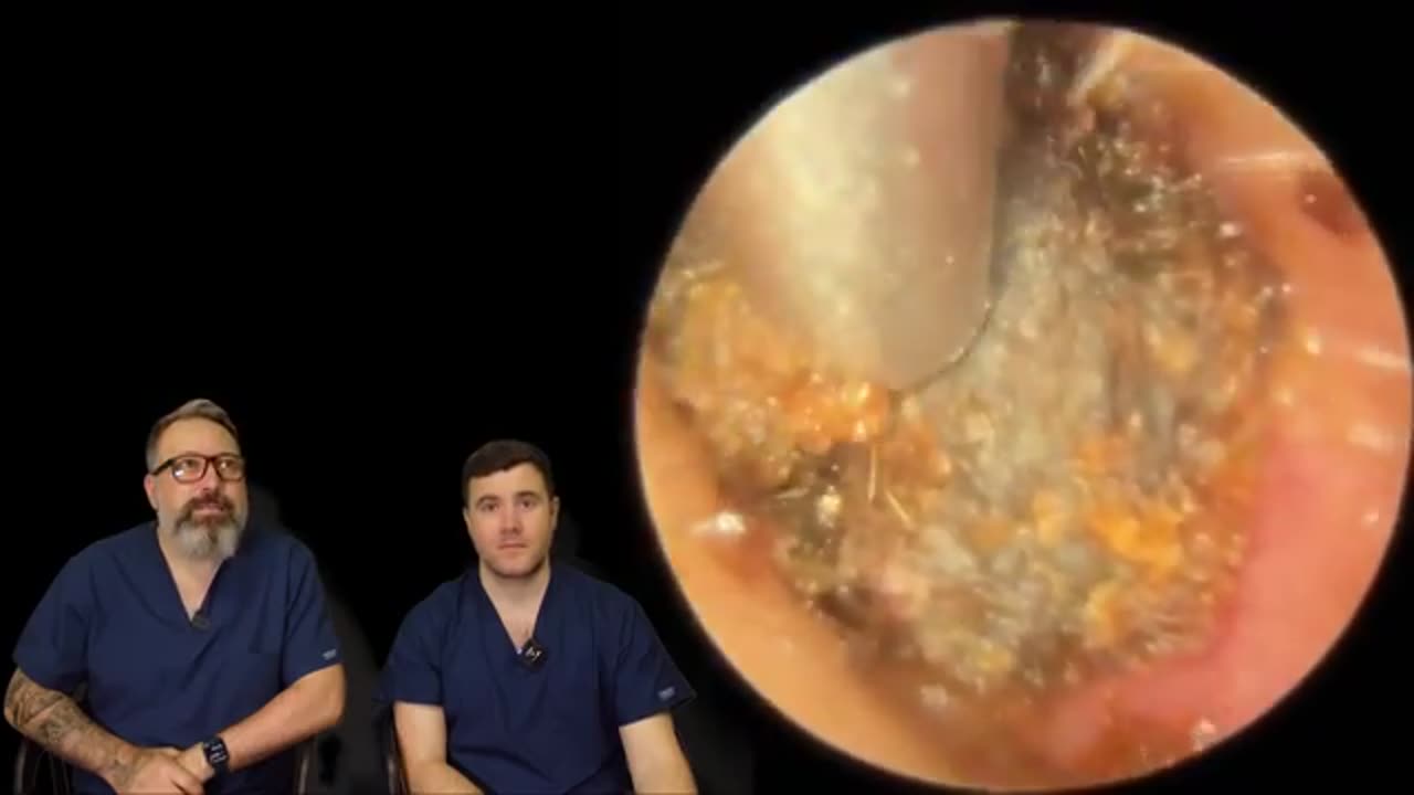 ROCK SOLID EAR WAX PLUG REMOVAL - ep 1