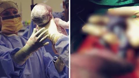 Doctor Delivers Baby, Sees Umbilical Cord & Realizes a Shocking Miracle!
